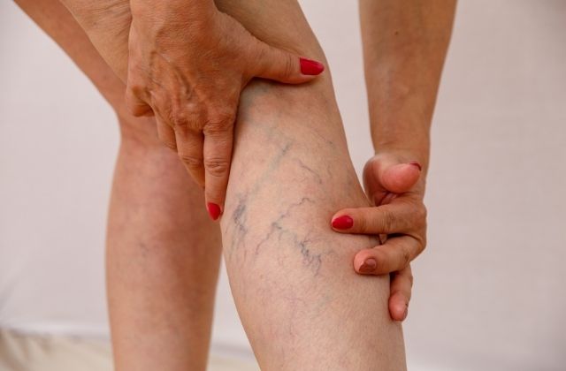 Żylaki na nogach przed zabiegiem skleroterapii w Derm-Estetyce
