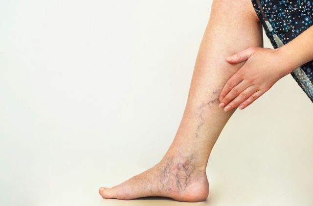 Żylaki nóg leczone metodą VenaSeal w Klinice Genesis